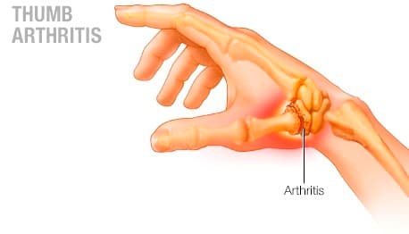 What Thumb Brace is Best for Thumb Arthritis?