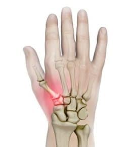 Thumb Arthritis: Understanding the 4 Stages and How to Manage It