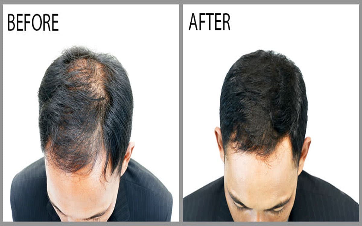 Best Hair Regrowth Treatment for Men – Restored Confidence Hair Regrowth Treatments for Men