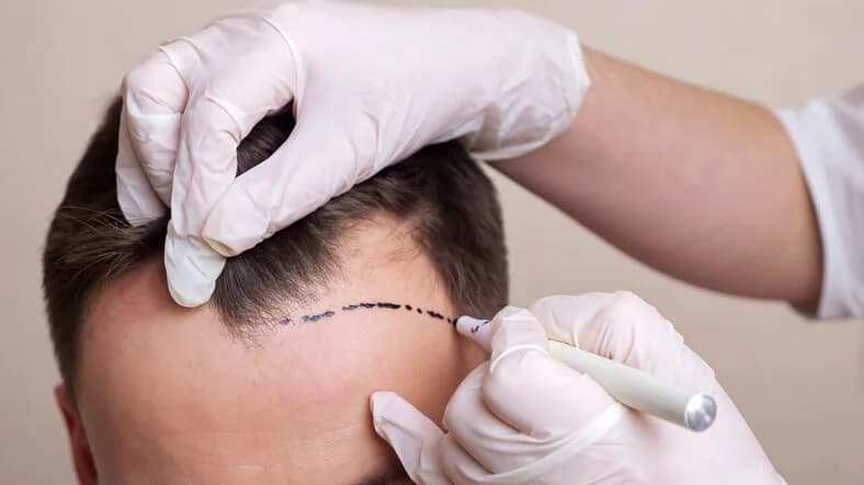 Best Hair Loss Treatment for Men: Regrowth Options That Work