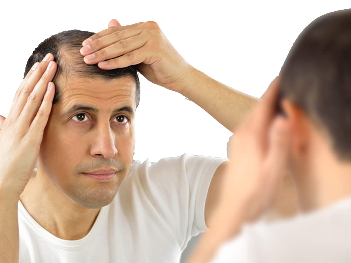 The Truth About the Best Hair Loss Treatments for Men in 2025