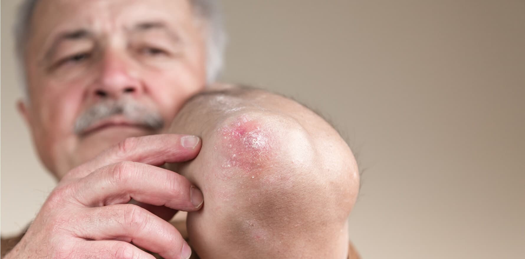 Skin Rash in the Elderly: Common Causes, Symptoms, and Care Tips