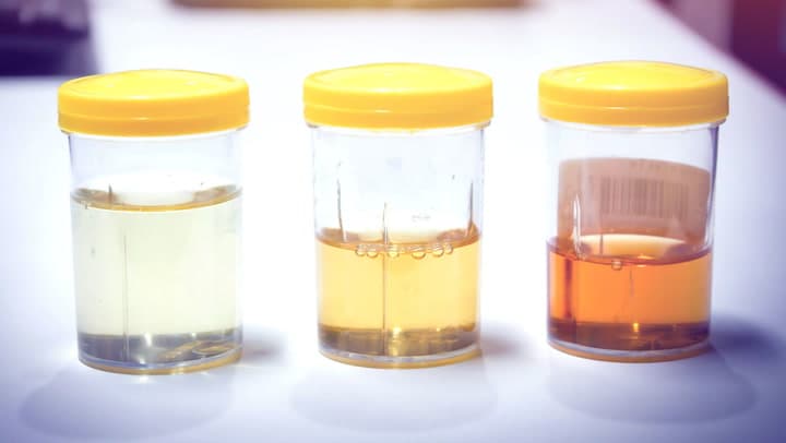 Why Is Urine Yellow?